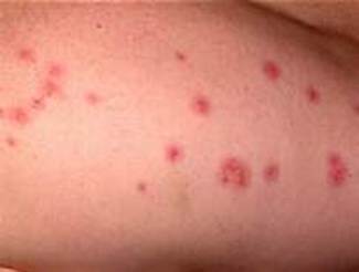 Bedbugs can leave itchy, skin rashes and cause loss of sleep and other effects